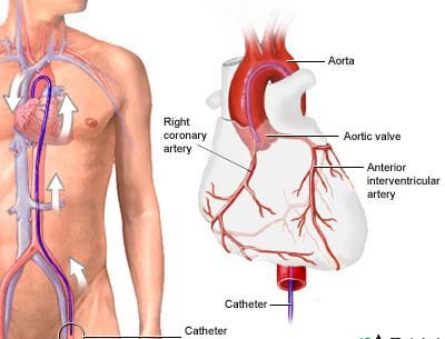 Coronary angiography (femoral & radial routes)