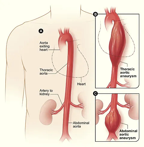 Thoracic aortic aneurysm repair