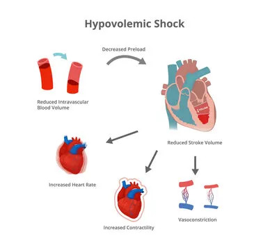 Hypovolemic shock