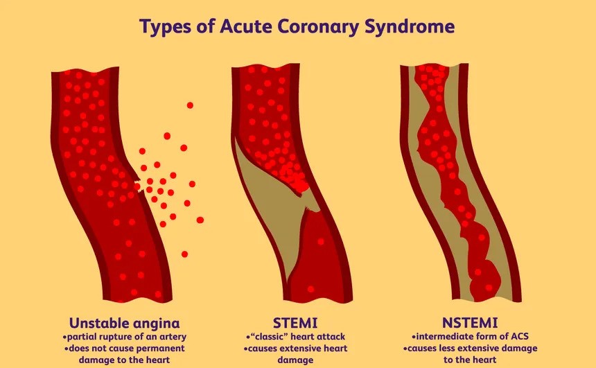 Acute Myocardial Infarction (STEMI/NSTEMI)