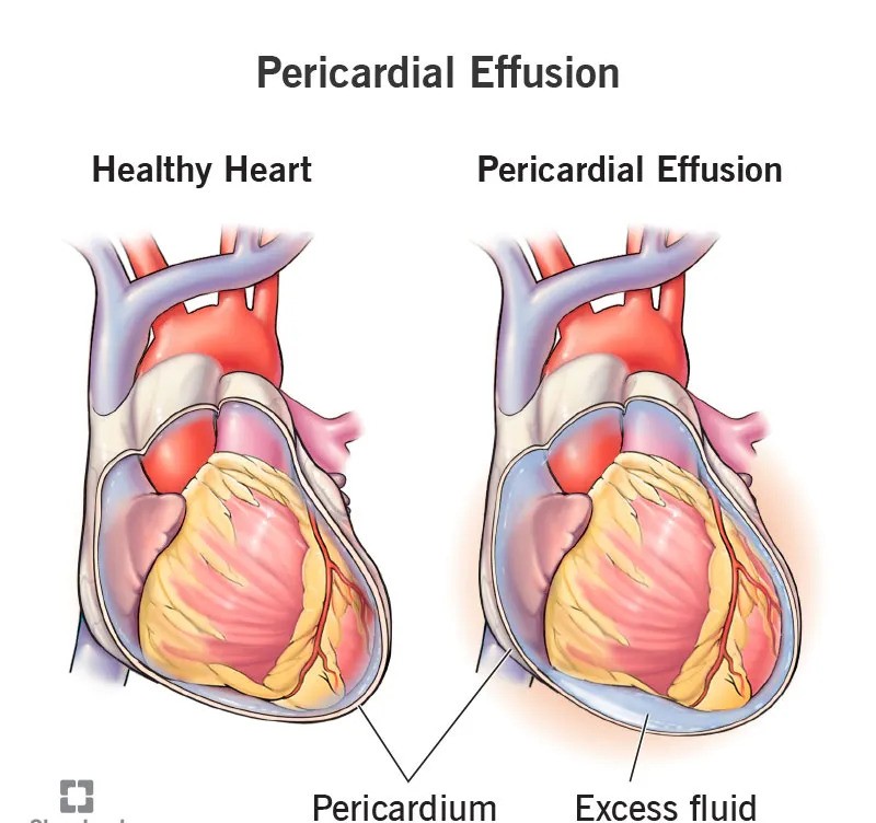  Pericardial Effusion / Tamponade Pulmonary / Respiratory Emergencies