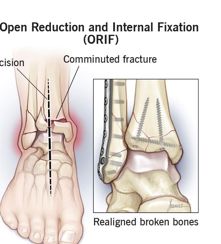 Open Reduction and Internal Fixation