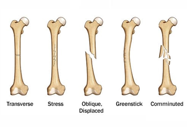  For long bone fractures (femur, tibia, humerus)
