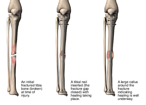 Intramedullary Nailing-femur, tibia, humerus