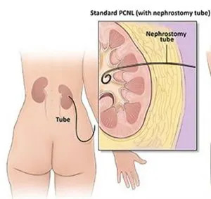 Percutaneous Nephrolithotomy (PCNL)