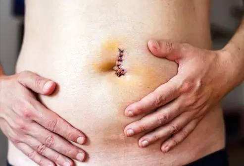 Umbilical Hernia Repair Surgery