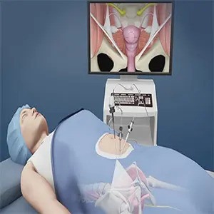 Laparoscopic hysterectomy